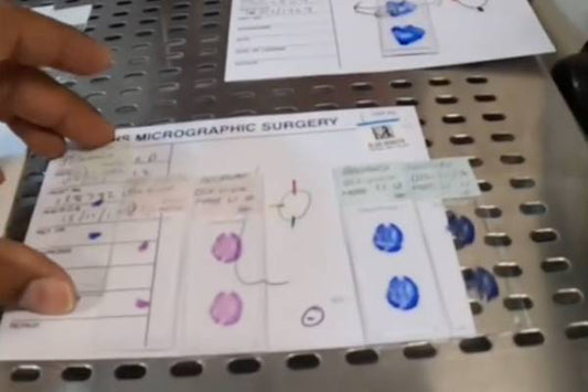 Is Mohs Surgery Right for You? Skin Cancer Treatment Options Explained